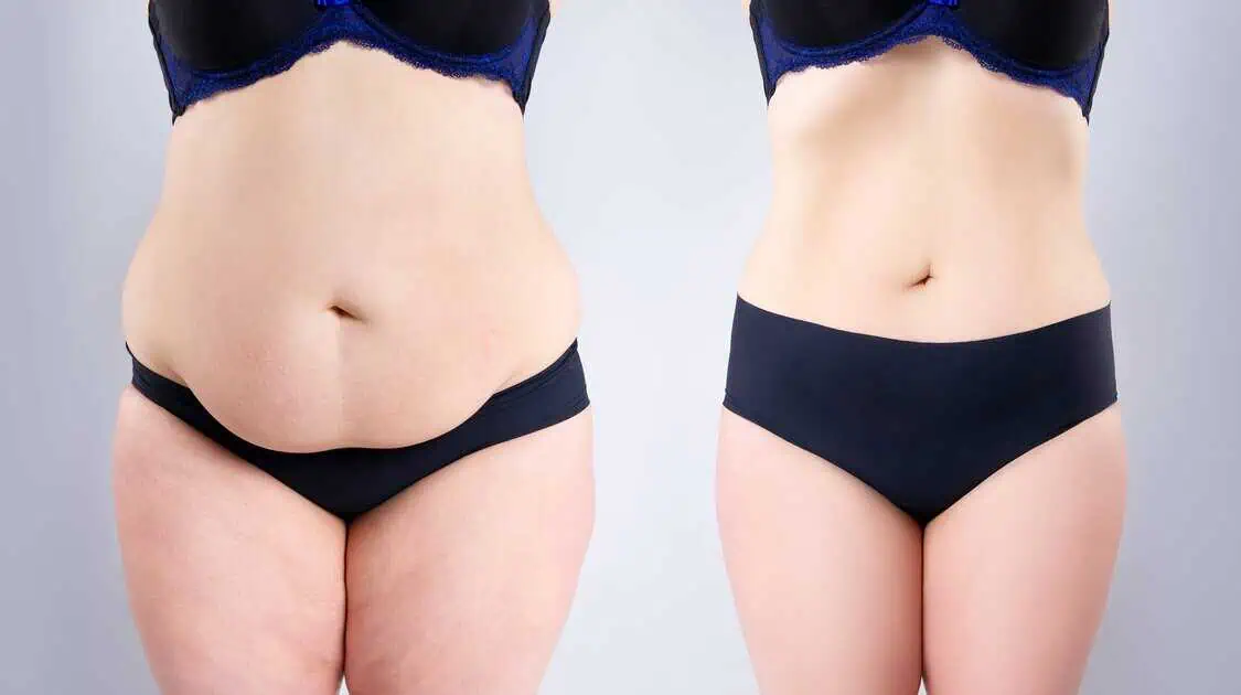 EmSculpt Neo session at Optimal Health in Provo