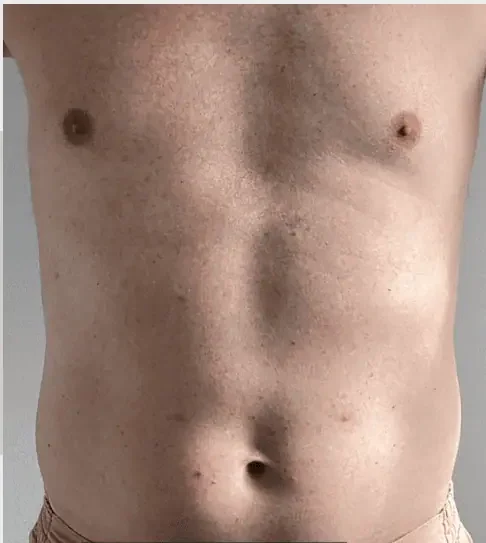 EmSculpt Neo abdomen, after 4 sessions