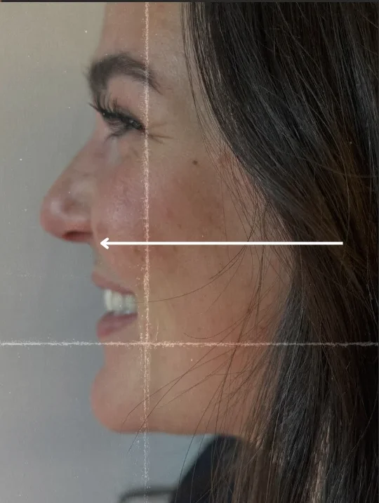 Nose Tox side view, after