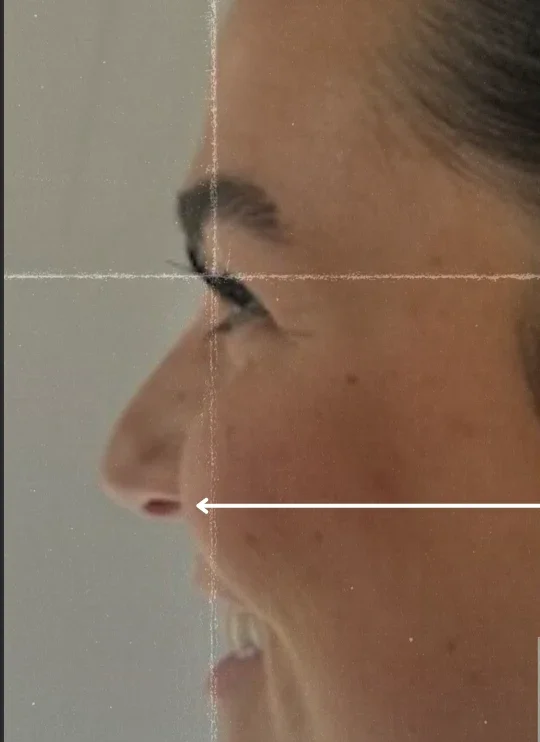 Nose Tox side view, before